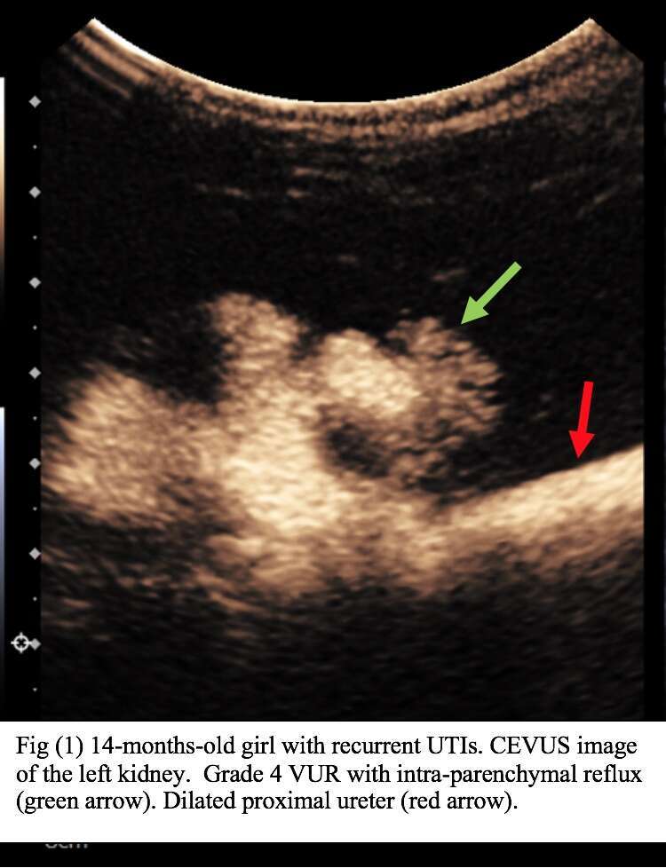 14-months-old girl with recurrent UTIs. CEVUS image Fig of the left kidney.  Grade 4 VUR with intra-parenchymal reflux (green arrow). Dilated proximal ureter (red arrow).